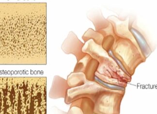 Healthy aging and bone health with Jen Avis Healthy aging and bone health with Jen Avis