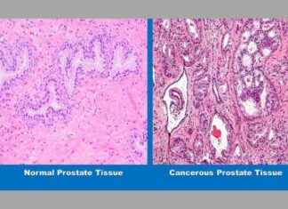 Study Suggests a Healthy Diet May Help Keep Low Grade Prostate Cancer From Progressing to More Dangerous States During Active Surveillance Study Suggests a Healthy Diet May Help Keep Low Grade Prostate Cancer From Progressing to More Dangerous States During Active Surveillance