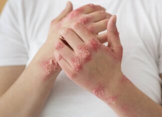 Psoriasis diet: What to eat, what to avoid A woman
