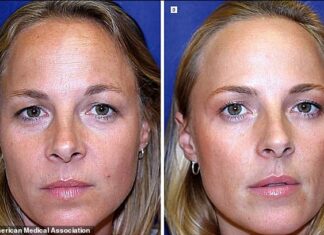 Fascinating study of twins reveals what happens to their brains when one eats healthy and the other doesn’t Like the fruit and vegetable study, a separate 2024 study showed the difference in twins who received very few Botox injections - image A - next to twin who got Botox regularly - image D