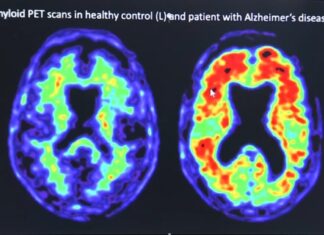 Up to 4 in 10 people could develop dementia after 55. What you can do to lower your risk Up to 4 in 10 people could develop dementia after 55. What you can do to lower your risk
